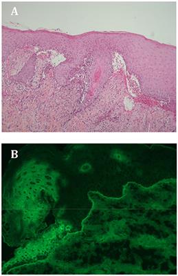 Mucous Membrane Pemphigoid, Bullous Pemphigoid, and Anti-programmed Death-1/ Programmed Death-Ligand 1: A Case Report of an Elderly Woman With Mucous Membrane Pemphigoid Developing After Pembrolizumab Therapy for Metastatic Melanoma and Review of the Literature